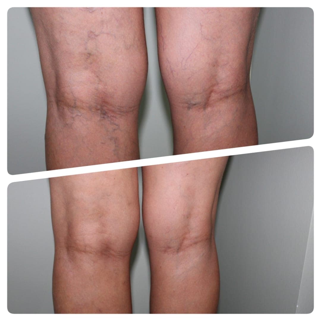 Resultado antes e depois de tratamento vascular - caso 2