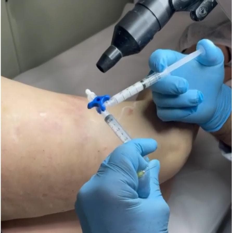 Dr. José Carlos realizando escleroterapia com espuma