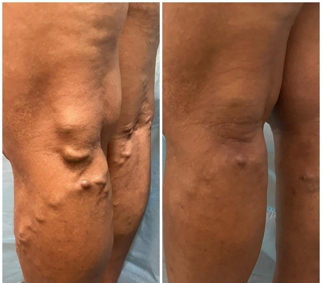 Resultado — caso 3: resultado de escleroterapia
