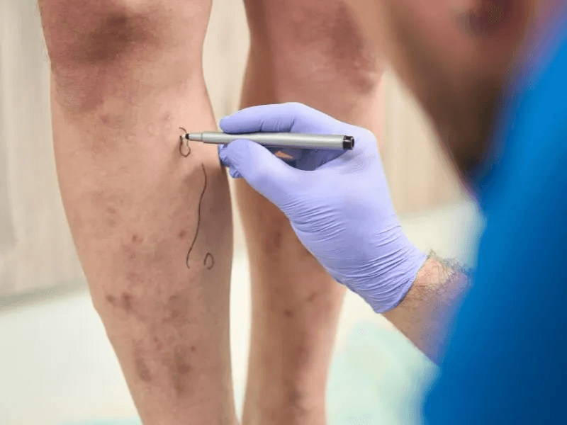 Escleroterapia Simples com Glicose