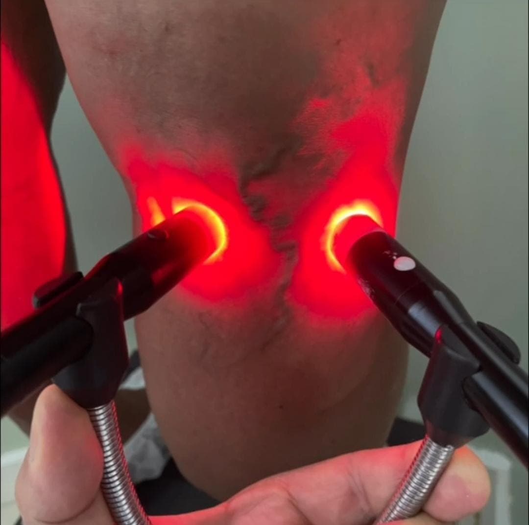 Macroescleroterapia com Espuma